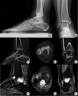 Posterior ankle arthroscopic treatment of a talar chondroblastoma with allograft and a platelet-rich plasma-fibrin glue: A case report and literature review